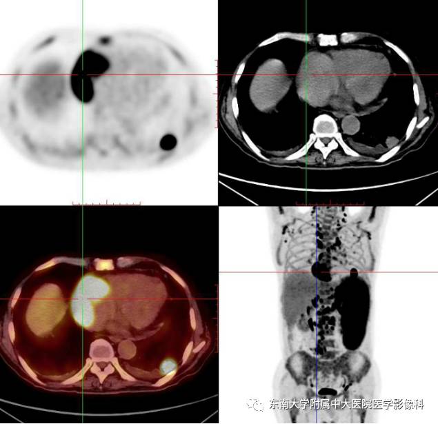 【病例】脾脏肿大两例PET/CT影像诊断与鉴别
