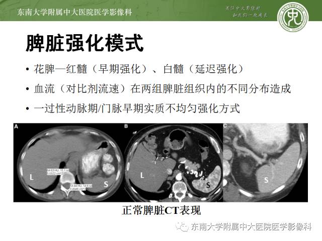 【病例】脾脏肿大两例PET/CT影像诊断与鉴别