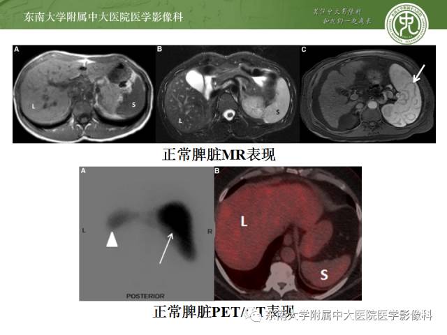 【病例】脾脏肿大两例PET/CT影像诊断与鉴别