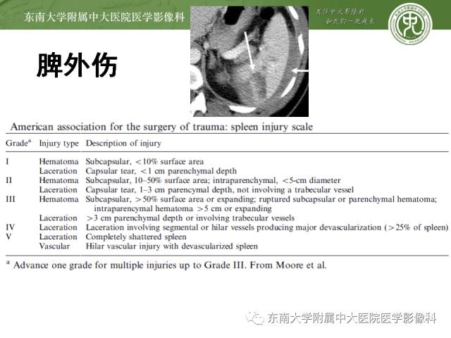 【病例】脾脏肿大两例PET/CT影像诊断与鉴别