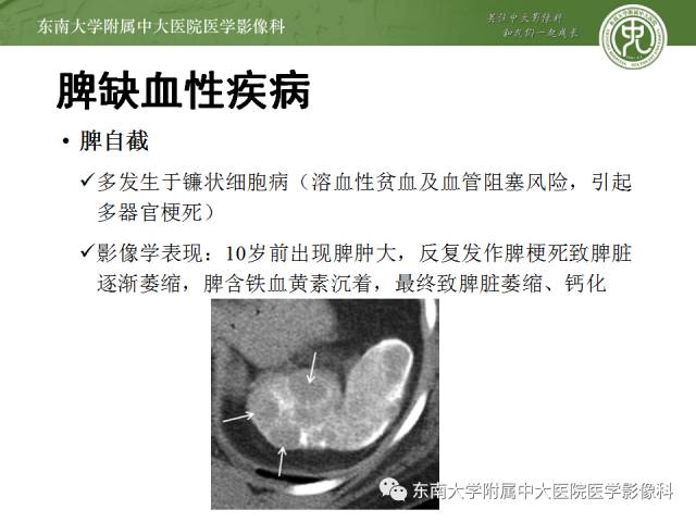 【病例】脾脏肿大两例PET/CT影像诊断与鉴别