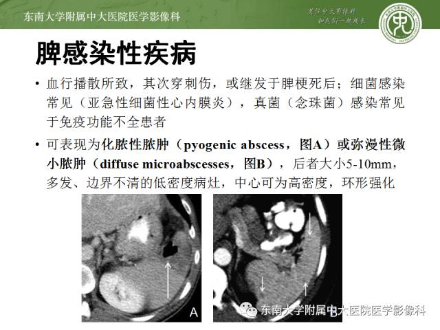 【病例】脾脏肿大两例PET/CT影像诊断与鉴别
