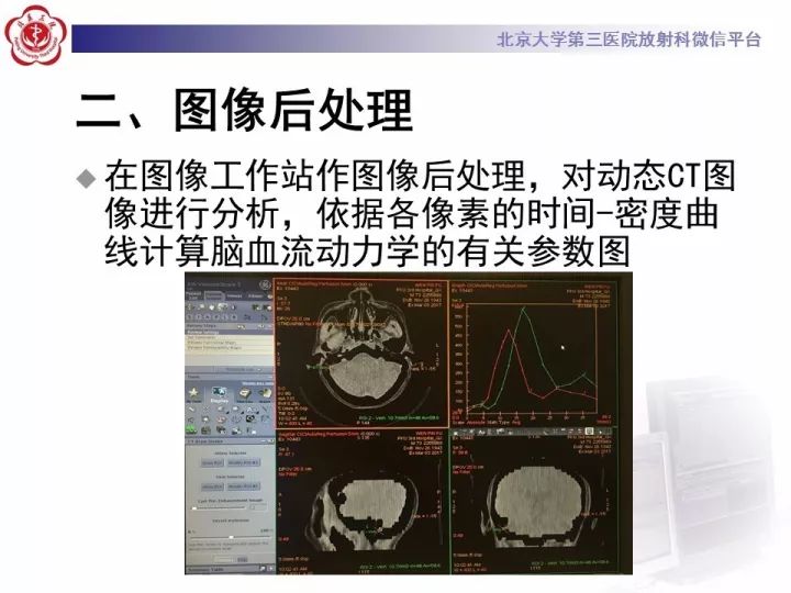 【PPT】脑CT灌注成像
