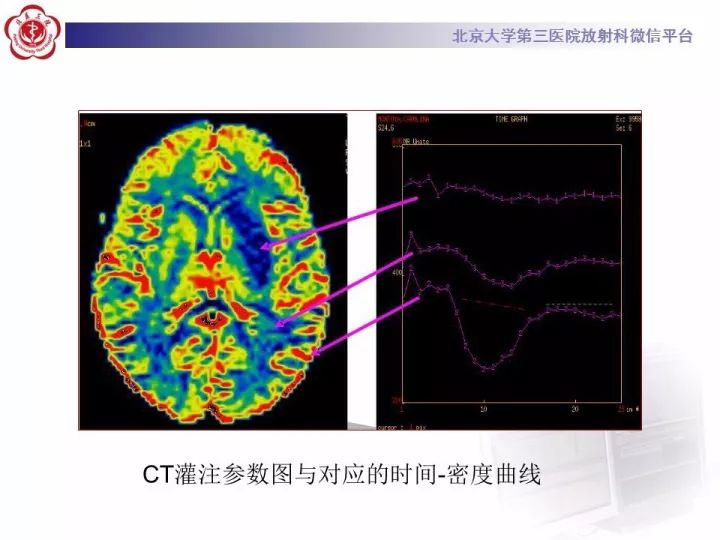 【PPT】脑CT灌注成像