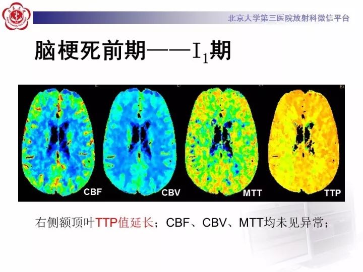 【PPT】脑CT灌注成像