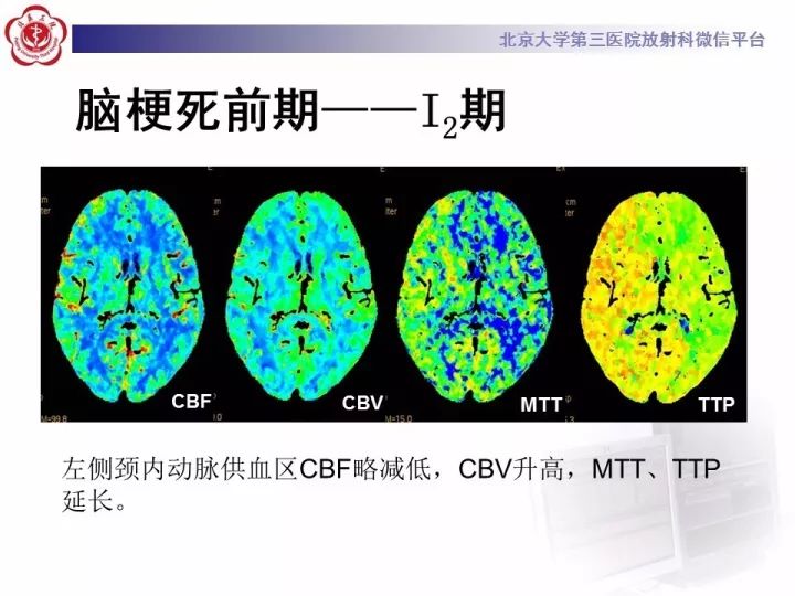 【PPT】脑CT灌注成像