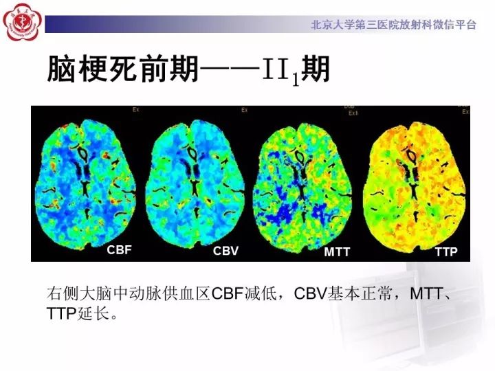 【PPT】脑CT灌注成像