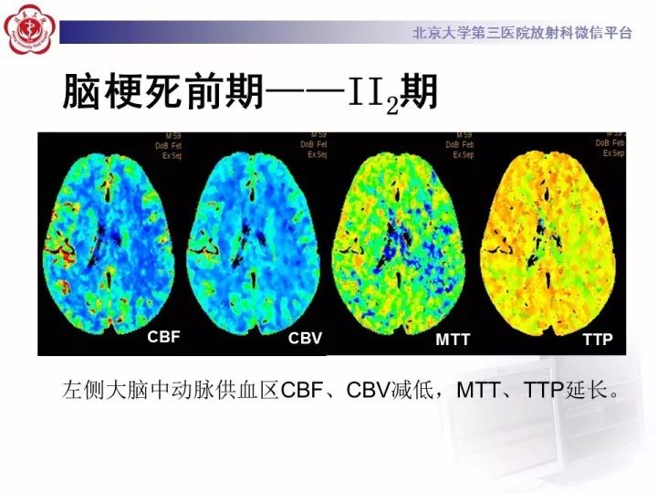 【PPT】脑CT灌注成像