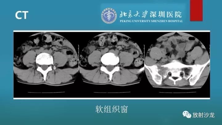 【病例】骶骨原始神经外胚层肿瘤1例CT及MR