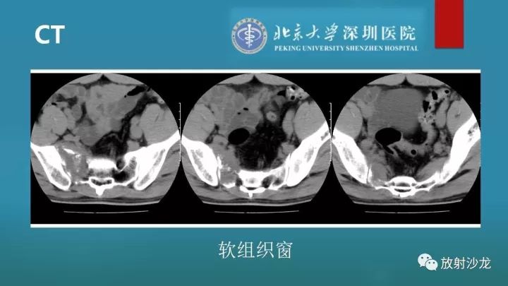 【病例】骶骨原始神经外胚层肿瘤1例CT及MR