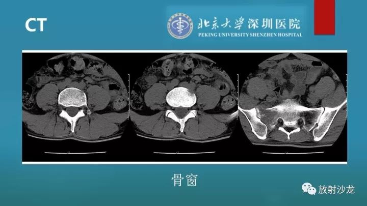 【病例】骶骨原始神经外胚层肿瘤1例CT及MR