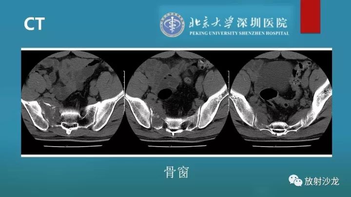 【病例】骶骨原始神经外胚层肿瘤1例CT及MR