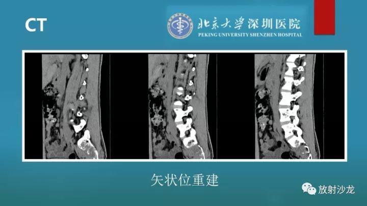 【病例】骶骨原始神经外胚层肿瘤1例CT及MR