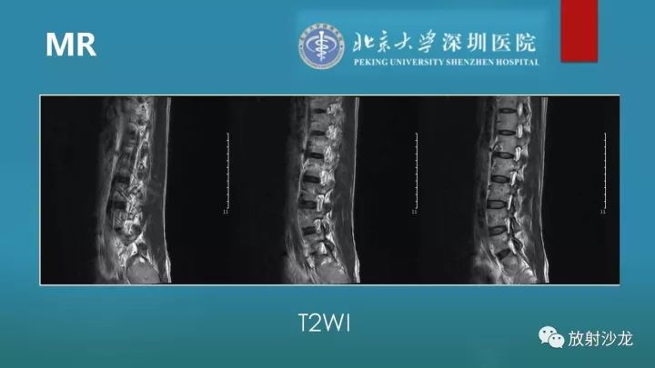 【病例】骶骨原始神经外胚层肿瘤1例CT及MR