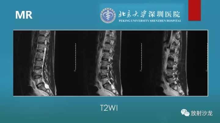 【病例】骶骨原始神经外胚层肿瘤1例CT及MR
