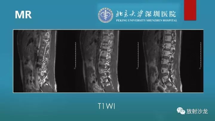 【病例】骶骨原始神经外胚层肿瘤1例CT及MR