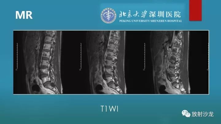 【病例】骶骨原始神经外胚层肿瘤1例CT及MR