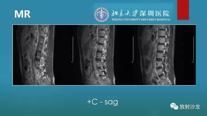 【病例】骶骨原始神经外胚层肿瘤1例CT及MR