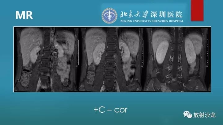 【病例】骶骨原始神经外胚层肿瘤1例CT及MR