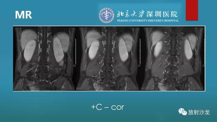 【病例】骶骨原始神经外胚层肿瘤1例CT及MR