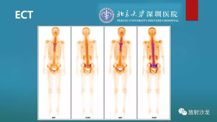 【病例】骶骨原始神经外胚层肿瘤1例CT及MR