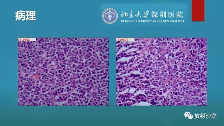 【病例】骶骨原始神经外胚层肿瘤1例CT及MR