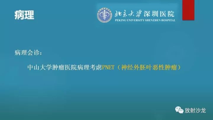 【病例】骶骨原始神经外胚层肿瘤1例CT及MR