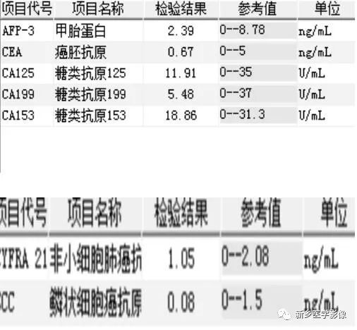 【病例】肺动脉静脉畸形1例CT 【病例】肺动脉静脉畸形1例CT