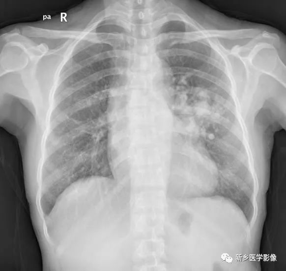 【病例】肺动脉静脉畸形1例CT 【病例】肺动脉静脉畸形1例CT