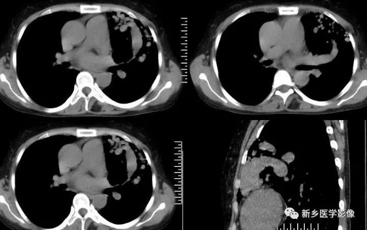 【病例】肺动脉静脉畸形1例CT 【病例】肺动脉静脉畸形1例CT