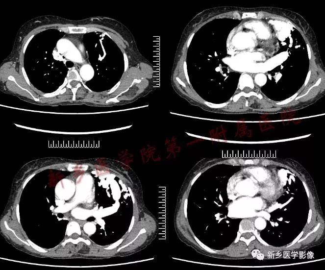 【病例】肺动脉静脉畸形1例CT 【病例】肺动脉静脉畸形1例CT