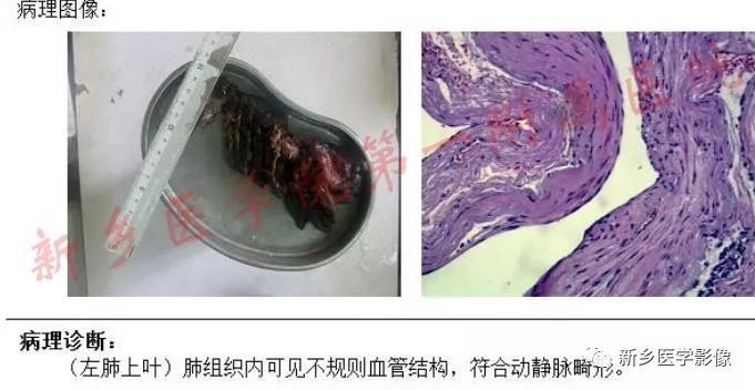 【病例】肺动脉静脉畸形1例CT 【病例】肺动脉静脉畸形1例CT