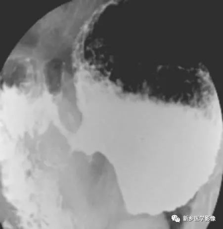 掌握胃肠道4种基本病变，深入领悟胃肠道疾病