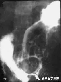掌握胃肠道4种基本病变，深入领悟胃肠道疾病