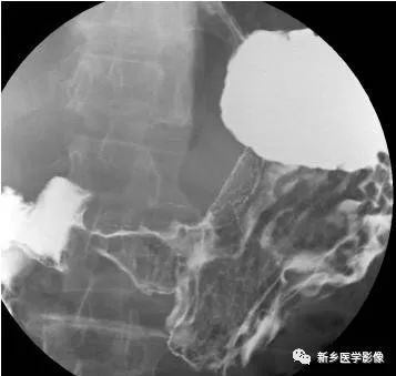 掌握胃肠道4种基本病变，深入领悟胃肠道疾病