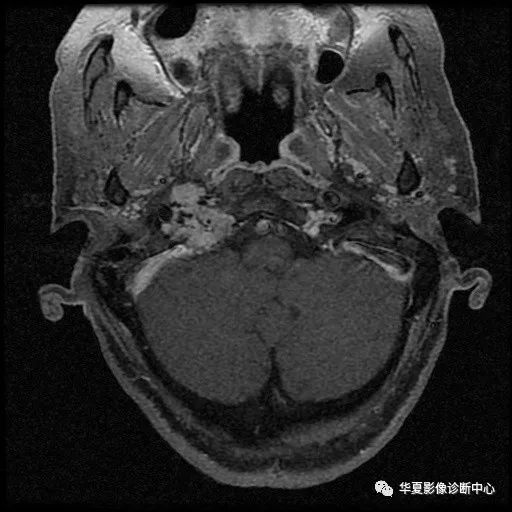 【病例】颈静脉球瘤1例MR影像表现 【病例】颈静脉球瘤1例MR影像表现