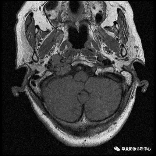 【病例】颈静脉球瘤1例MR影像表现 【病例】颈静脉球瘤1例MR影像表现