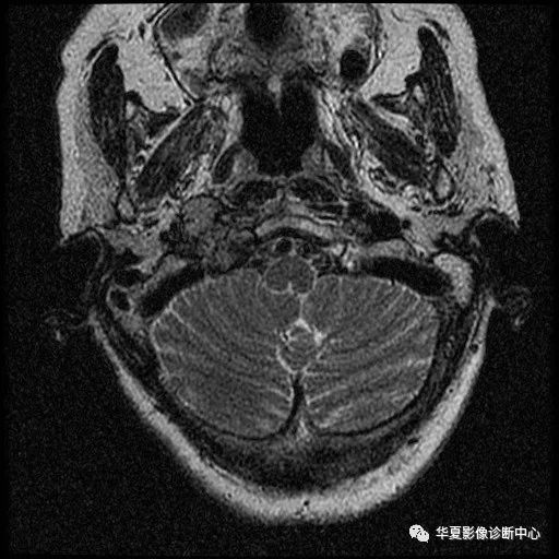 【病例】颈静脉球瘤1例MR影像表现