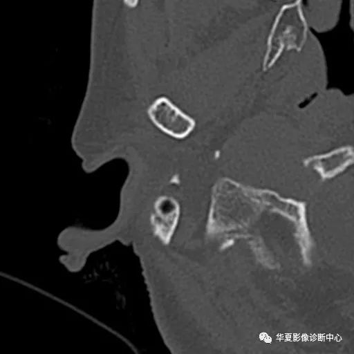【病例】颈静脉球瘤1例MR影像表现 【病例】颈静脉球瘤1例MR影像表现