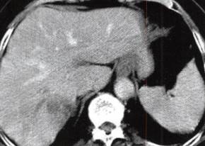 【病例】肝胆管细胞癌1例CT影像表现 【病例】肝胆管细胞癌1例CT影像表现