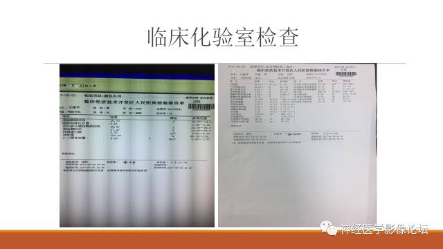 【病例】鞍旁分泌型脑膜瘤1例CT及MR