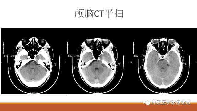 【病例】鞍旁分泌型脑膜瘤1例CT及MR