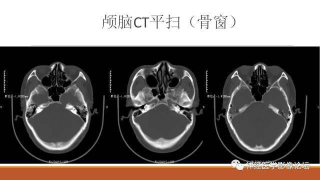 【病例】鞍旁分泌型脑膜瘤1例CT及MR