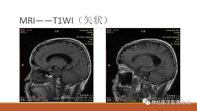 【病例】鞍旁分泌型脑膜瘤1例CT及MR