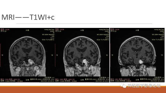 【病例】鞍旁分泌型脑膜瘤1例CT及MR