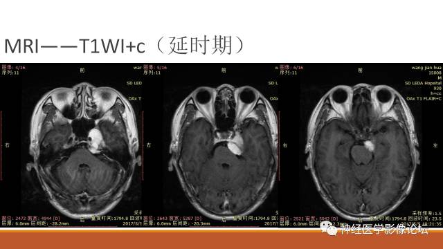 【病例】鞍旁分泌型脑膜瘤1例CT及MR