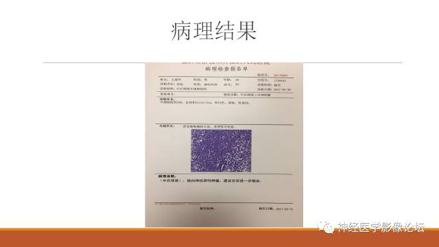 【病例】鞍旁分泌型脑膜瘤1例CT及MR