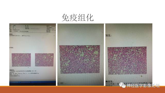【病例】鞍旁分泌型脑膜瘤1例CT及MR