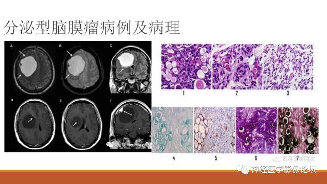 【病例】鞍旁分泌型脑膜瘤1例CT及MR
