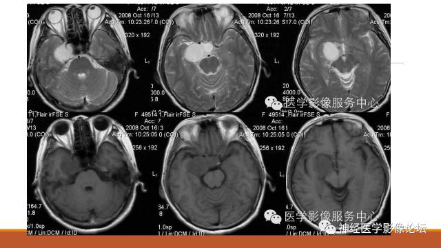 【病例】鞍旁分泌型脑膜瘤1例CT及MR